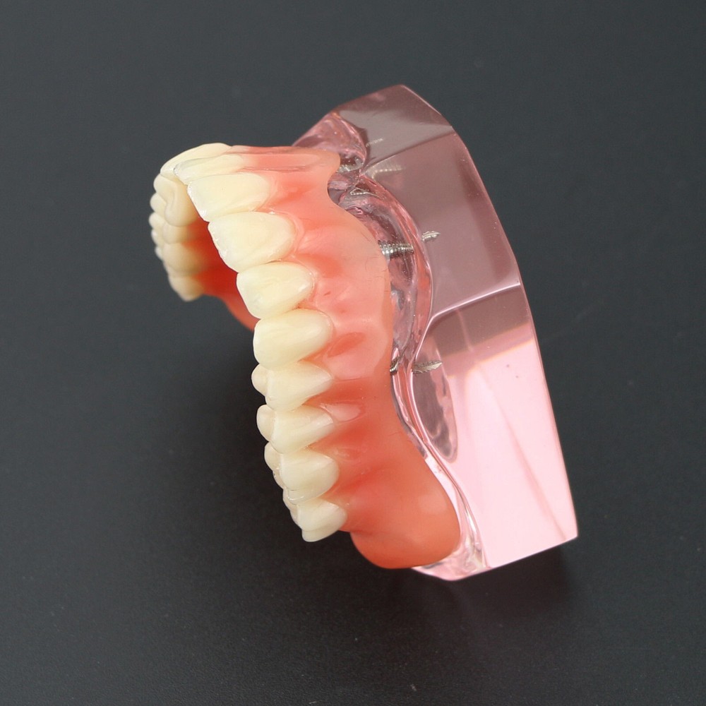 Dental Teeth Model Demo Overdenture Restoration With 4 Implants Upper Maxillary