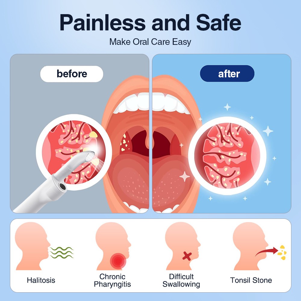 Visible Tonsil Stone Removal Kit with HD Camera Electronic Tonsil Stone Remover