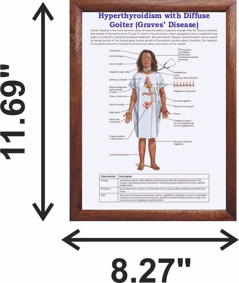 Hyperthyroidism with Diffuse Goiter Graves’ Disease) Chart 12x18 inches