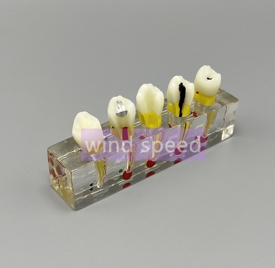 Dental Study Model Pulp Disease root canal curing Clinical Demonstration Analysi