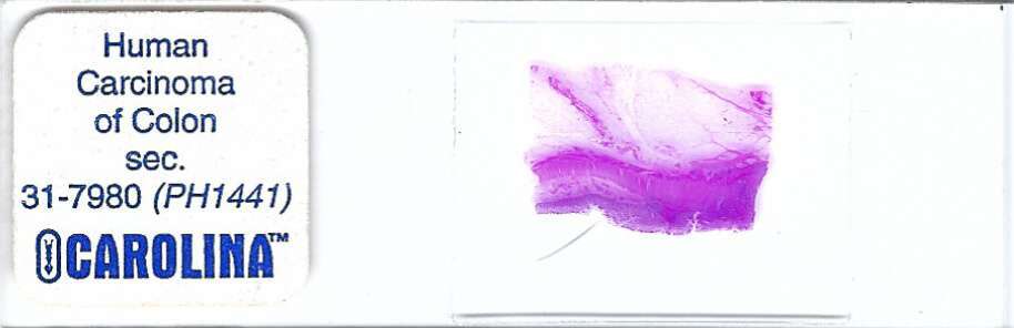 Human Carcinoma of Colon Pathology Microscope Slide