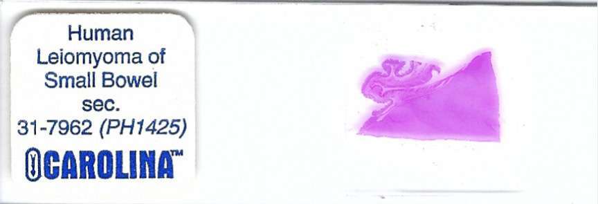 Human Leiomyoma of Small Bowel Pathology Microscope Slide