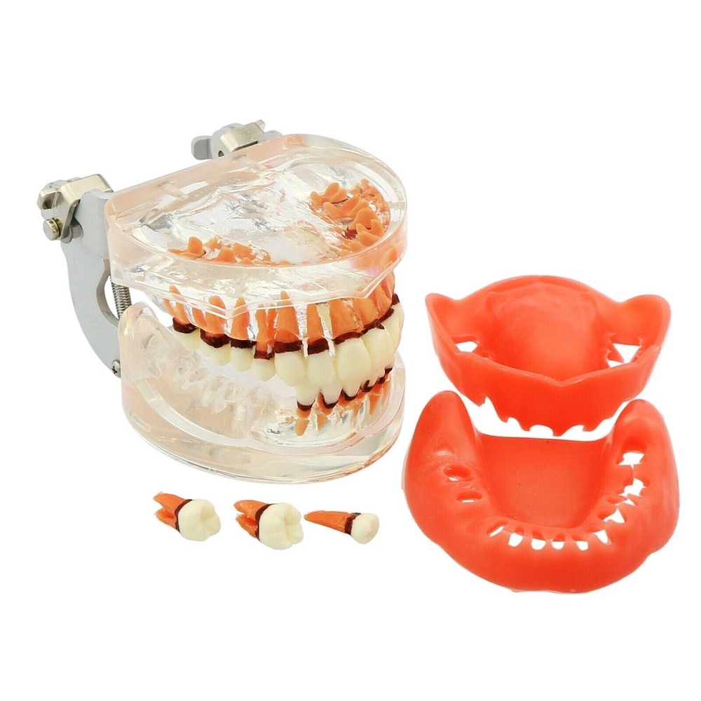 Dental Periodontal Pathological Disease M4017 Removable Teaching Study Model