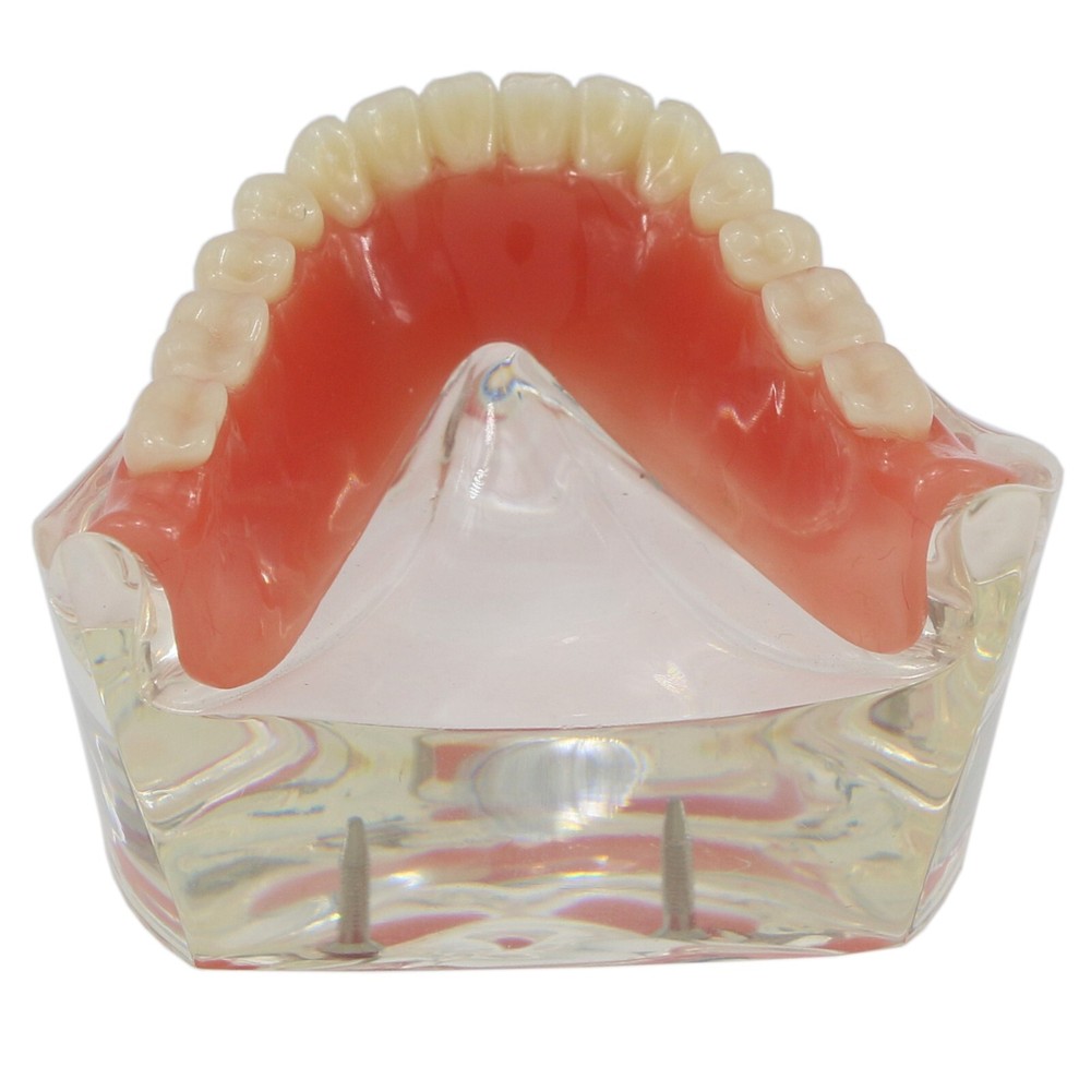 Dental Implant With 2 Implants Teeth Demo Model Overdenture Restoration Model