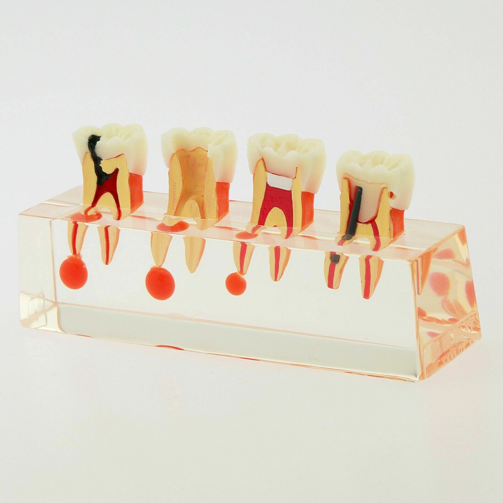1 Pc Dental Study Typodont Teeth Model #4018 4 Stage Endodontic Treatment Model