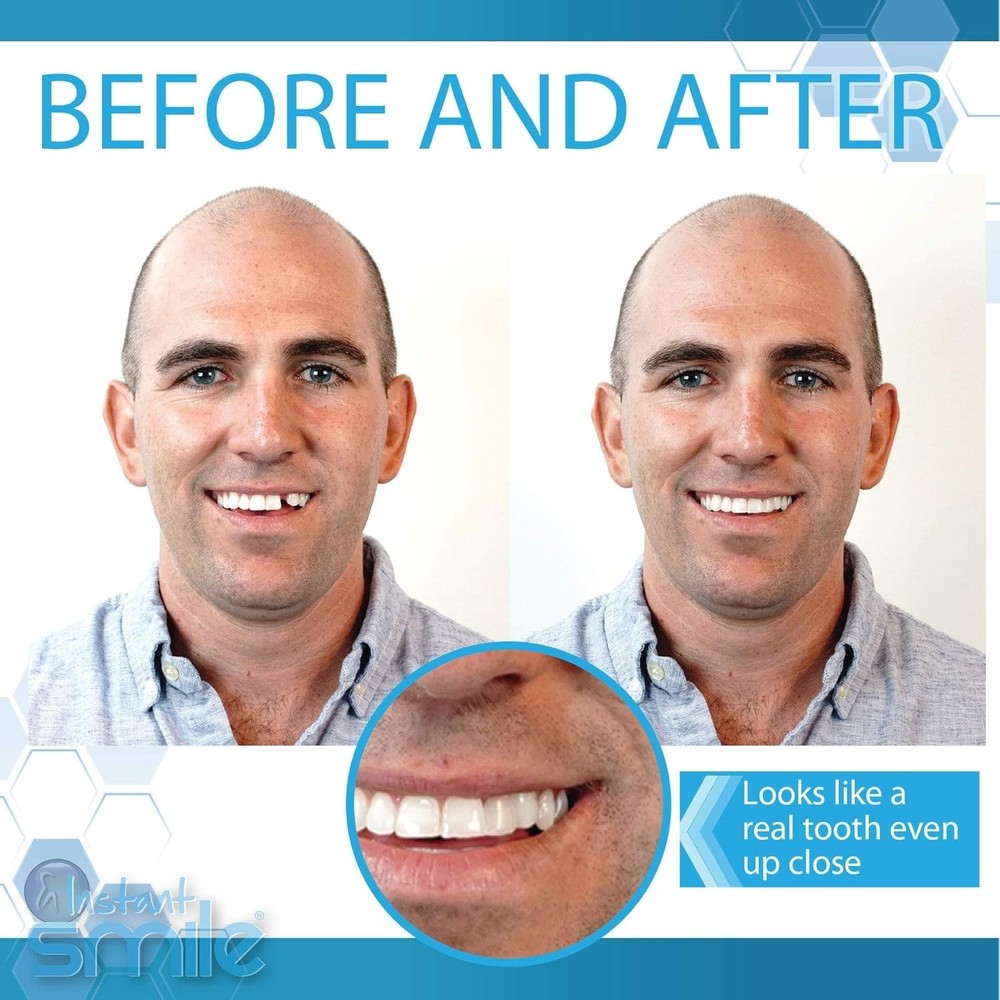 Complete Your Smile Temporary Tooth Replacement Kit - 40 Piece - White - Cust...
