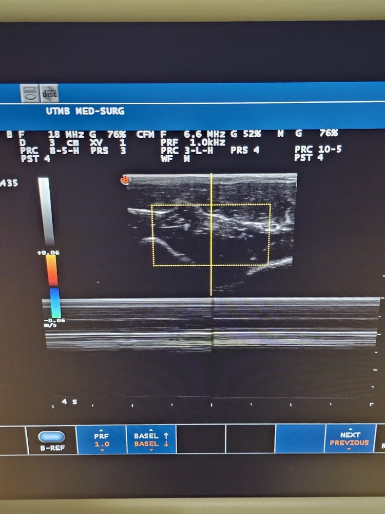 Esaote LA435 Linear Array Ultrasound Transducer Ref 9600173000