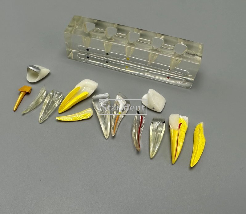 Dental Caries Teeth Model Detachable Abutment Teaching Study Models 4 times