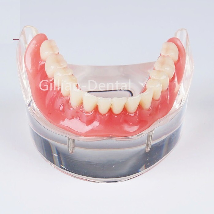 Dental Study Teach Teeth Model With Overdenture Inferior Demo 4 Implants