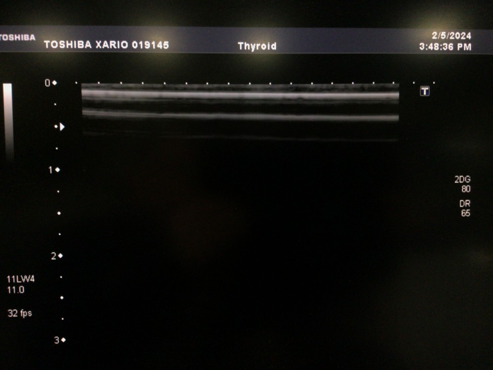Toshiba PLT-704SBT Linear Array Ultrasound Probe Great Condition