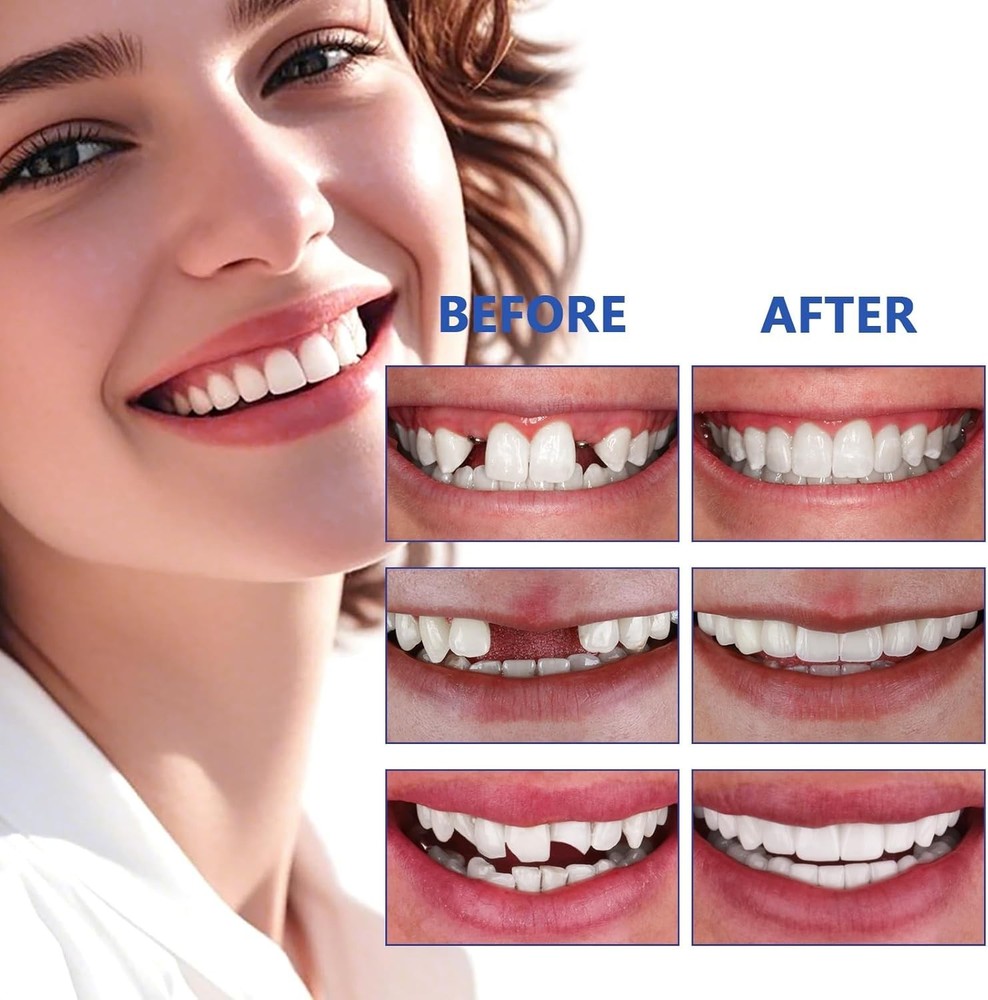 Teeth, Tooth Replacement Missing Teeth, Teeth Filling Kit Permanent with Tool,