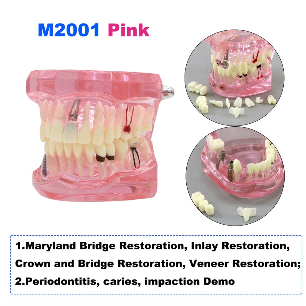 US Dental Teeth Model Ortho Implant Pathological Perio Practice Demo Study Model