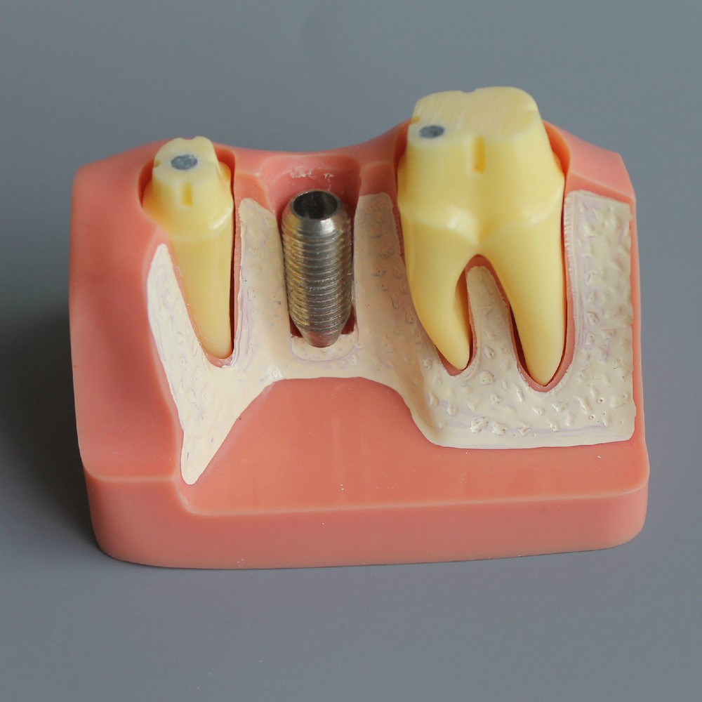 Dental Demonstration Removable Teeth Model Implant Analysis Crown Bridge Study