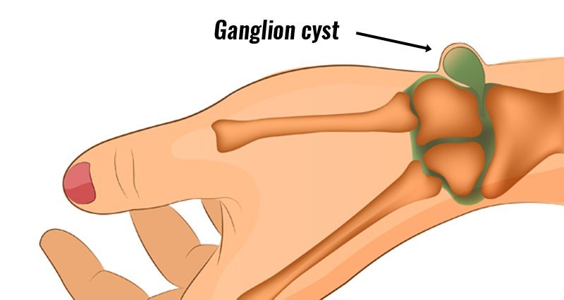 Ganglion cyst stimulator.