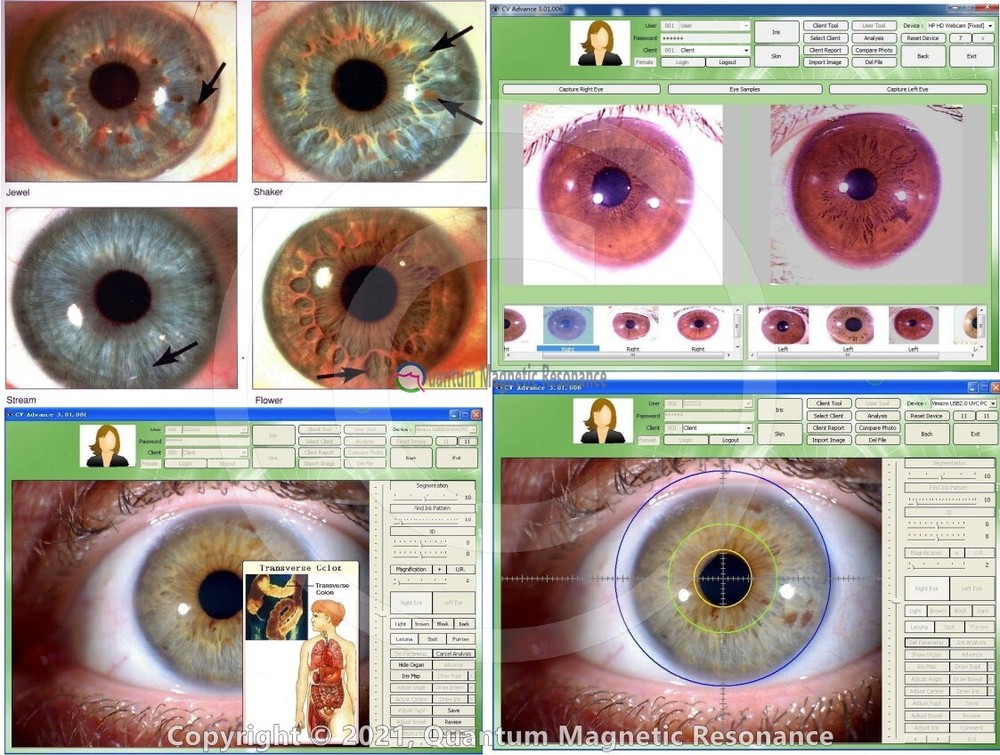 Analyzer Camera HD Iriscope Eye Camera with English Analysis Software for Eye US