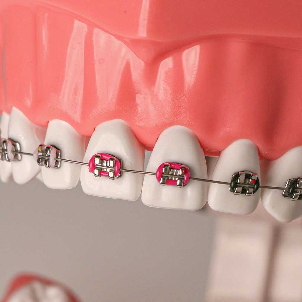 US Dental Typodont Demonstration Teeth Model with Braces For Patient Teach Study