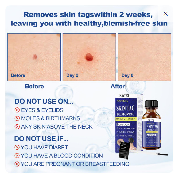 Zrizl Advanced Skin Tag Remover 30mL 1.01 oz Max Formula