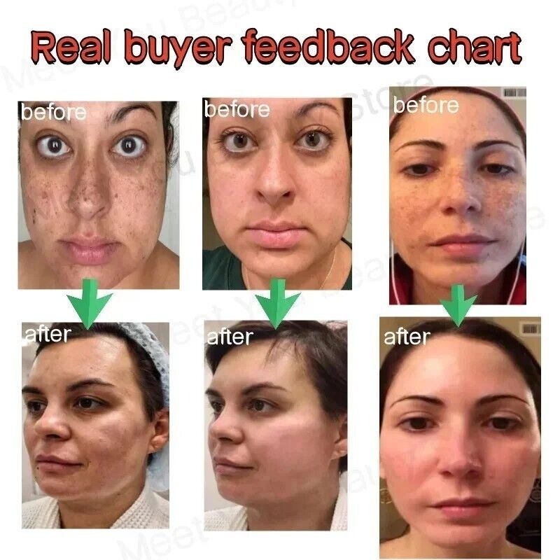 Powerful Spot-removing Whiten Cream Pigmentation Melasma Dark Spots