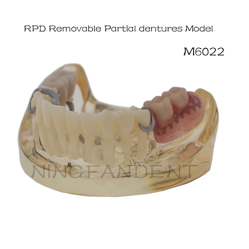 Dental Implant RPD Restoration Model Removable Partial Denture Lower 2 Implants