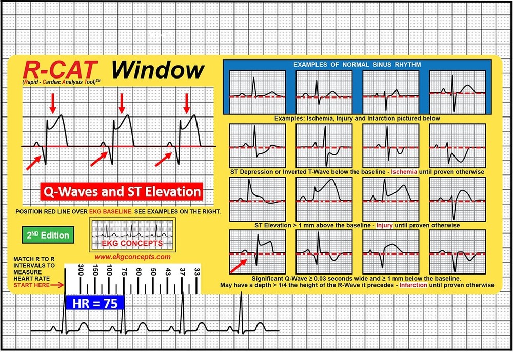 EKG Window 2nd Edition
