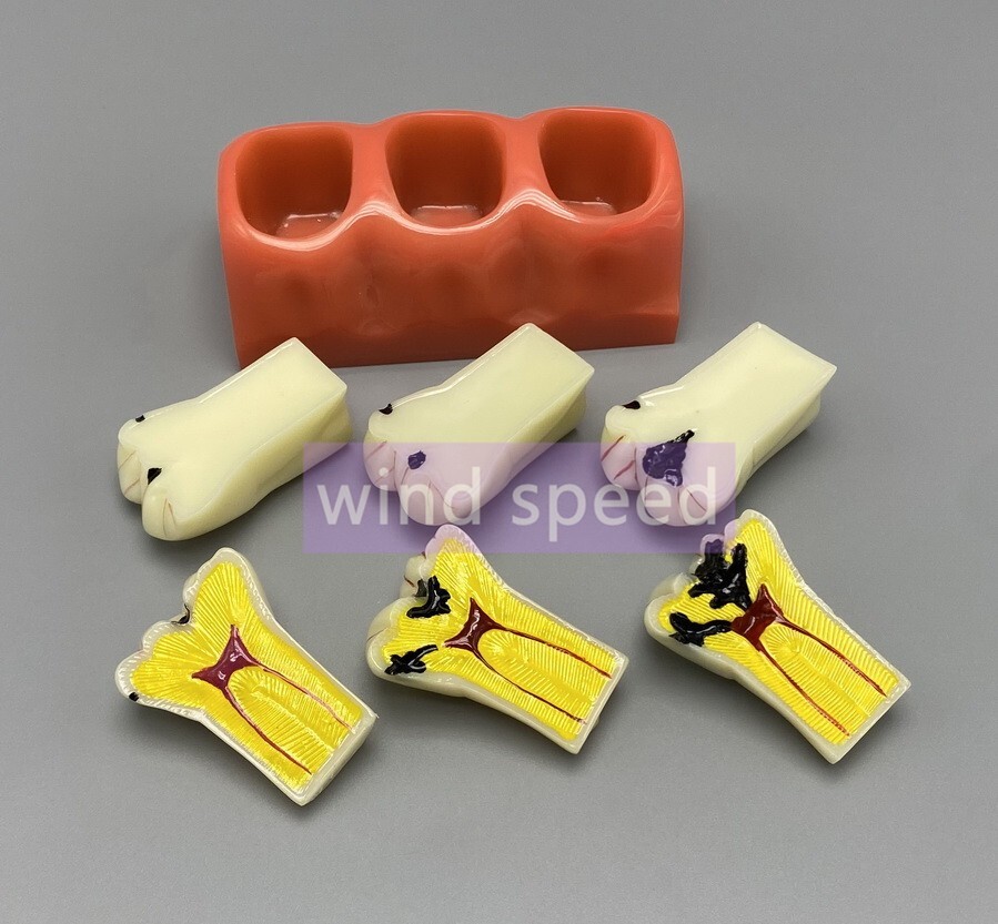 Dental Teaching Model 4 Times Caries Disassembling Comparations Implant Model