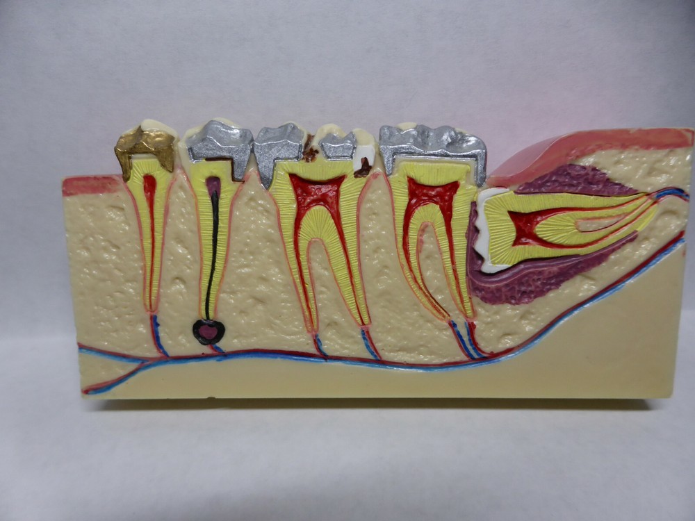 Typodont, Common Dental Pathologies Model, Patient instruction, x- section