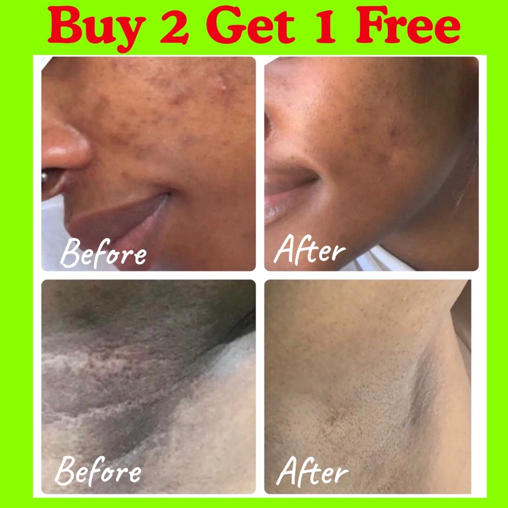 Body Bleaching Cream Max Strength Whitening Lightening AHA