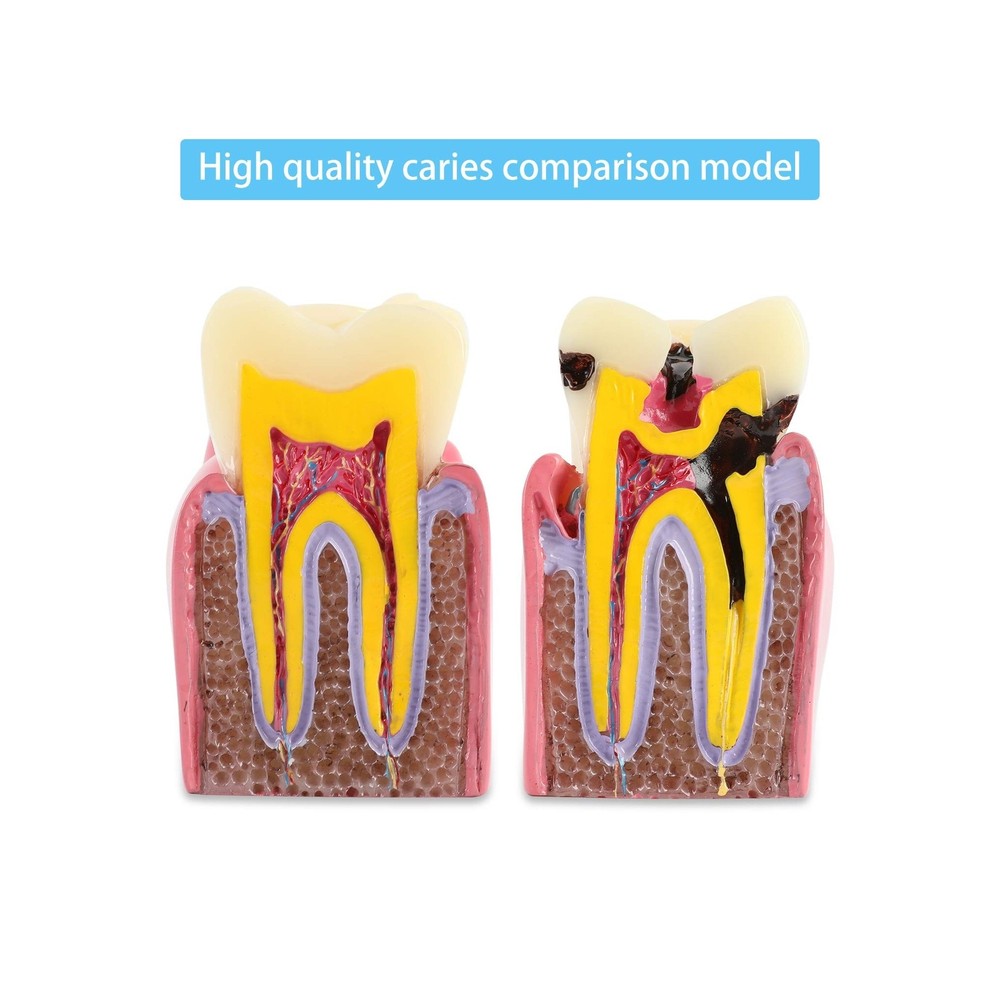 Dental Caries Tooth Model 6 Times Decay Teeth Comparative Study Model, Caries...