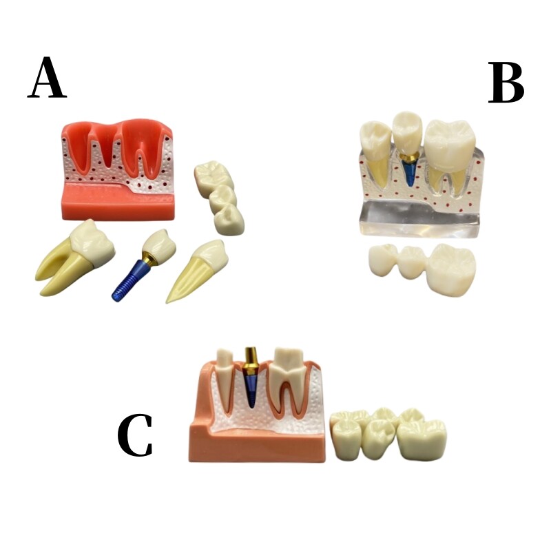 Dental Teaching Model Removable Communication Models Crown Bridge 4 Times Impant