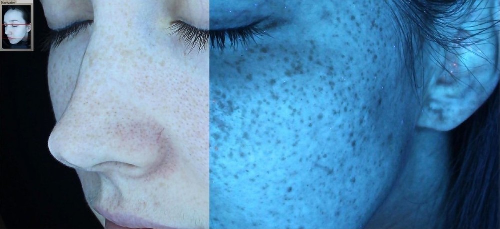 GLIMPSE – PROFESSIONAL SKIN ANALYZER 2024