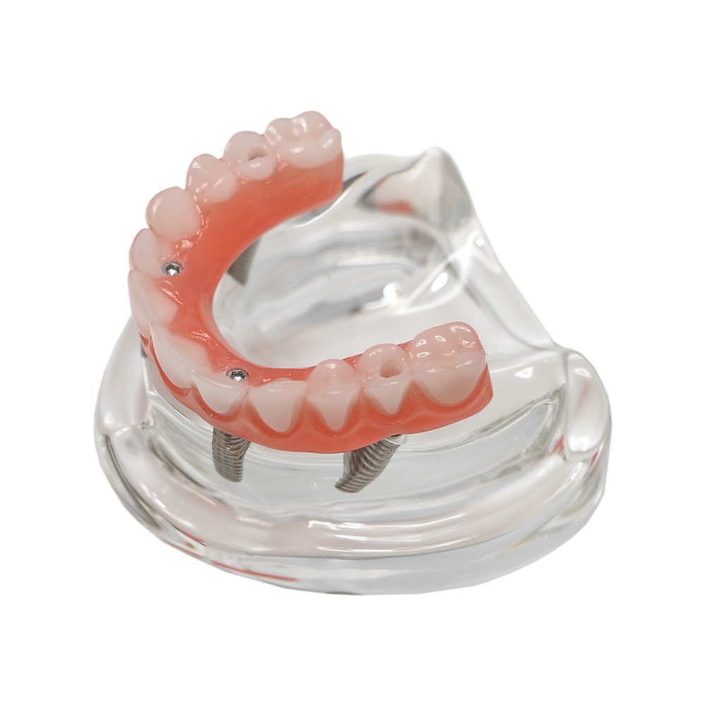 Dental Implant Model PRD Removable Partial Dentures Overdenture treatment Model