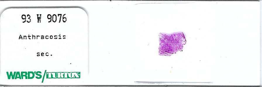 Anthracosis Pathology Microscope Slide
