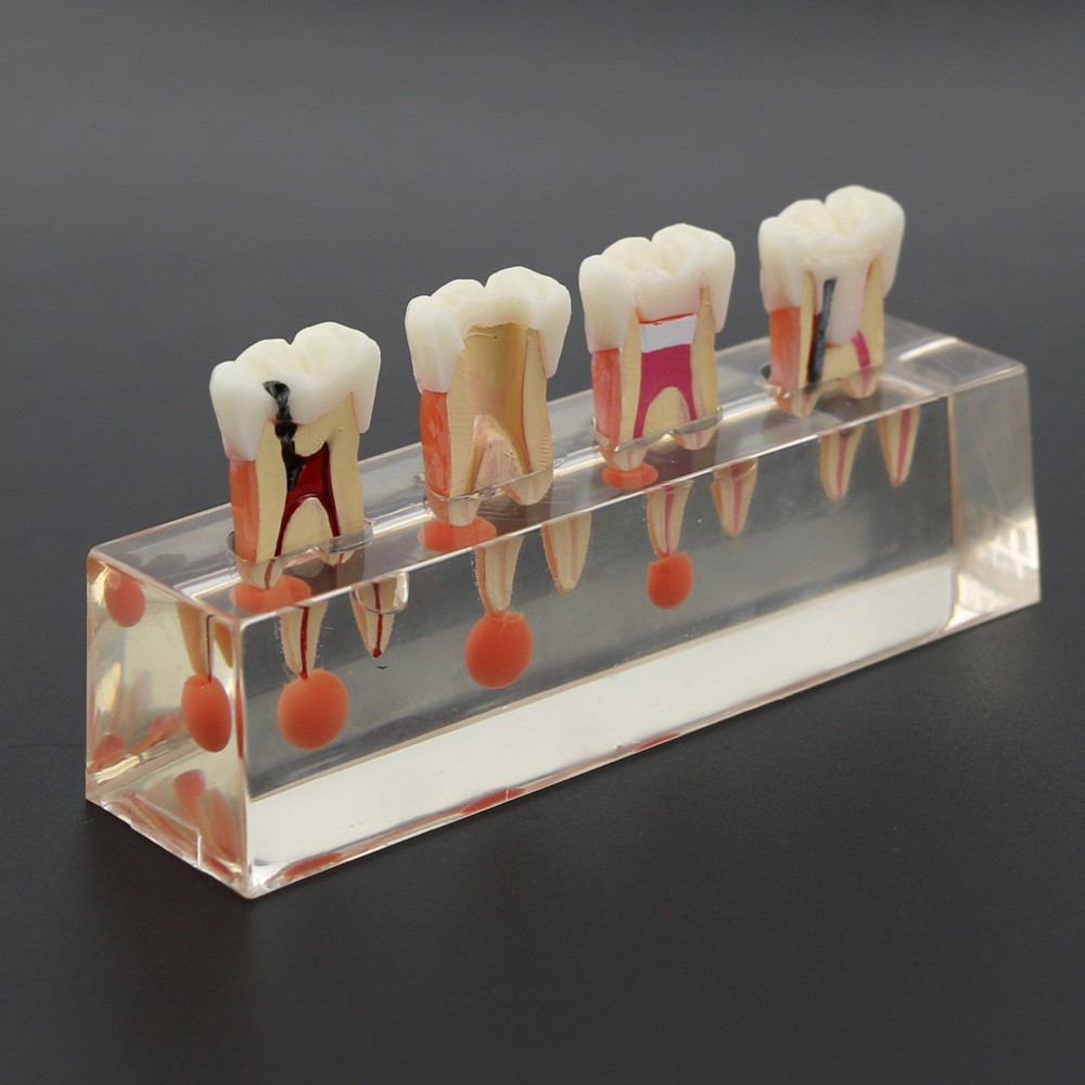 1 Set Dental Teeth Model #4018 01 - 4-Stage Endodontic Treatment Study Model