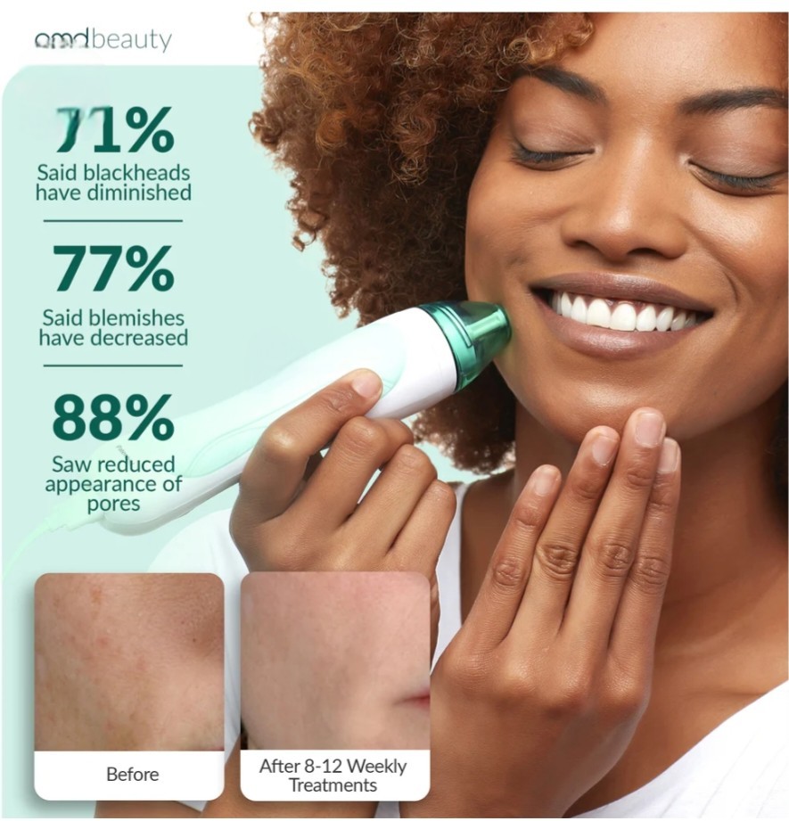 Working PMD Personal Microderm Pro At-Home Microdermabrasion Device Teal