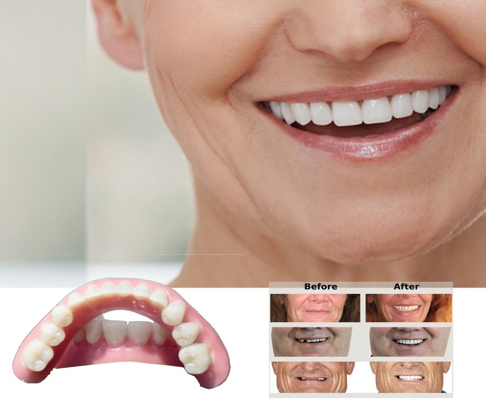 DIY Denture Kit with Impression, Do-It-Yourself Partial Denture Solution, Small