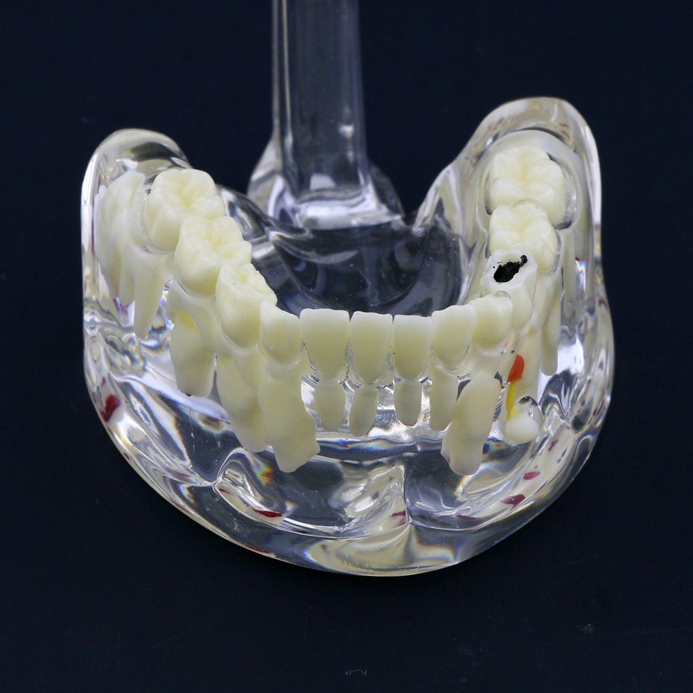 Dental Children Pediatric Pathology Demonstration Study Tooth Teeth Model 4002