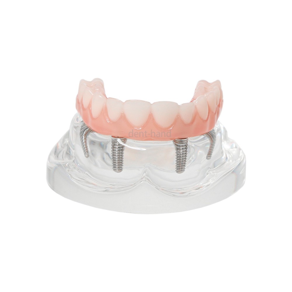 US Dental Overdenture Upper/Lower 4 Implants Demo Teeth Restoration Model