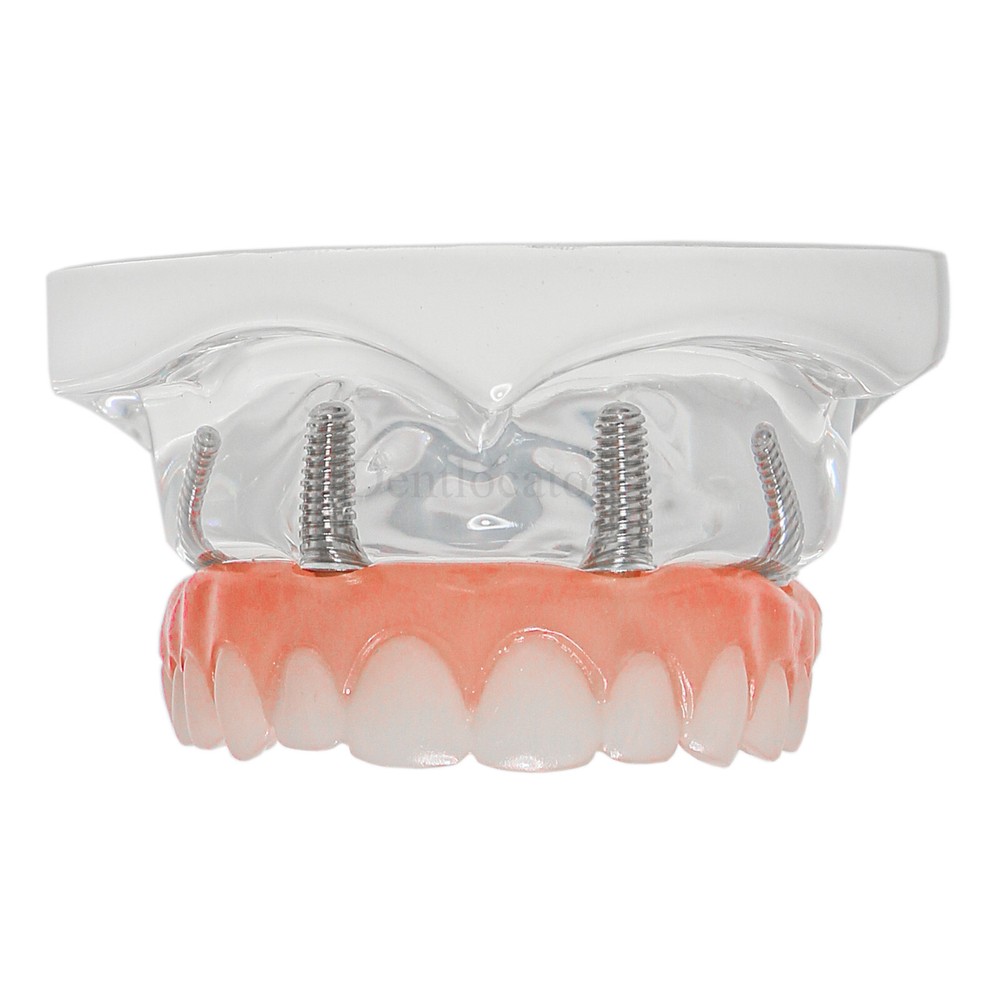 US MultipleType Dental Typodont Teeth Model Ortho Implant Practice Teaching Demo