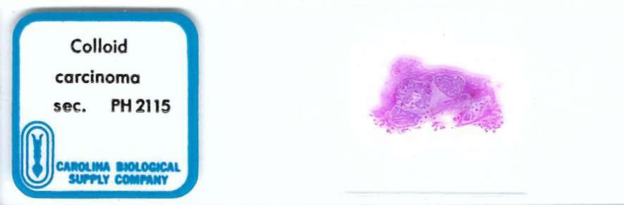 Human Colloid Carcinoma Pathology Microscope Slide