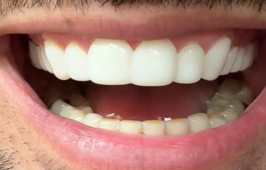 Custom Upper or Lower Cosmetic Click on Veneer