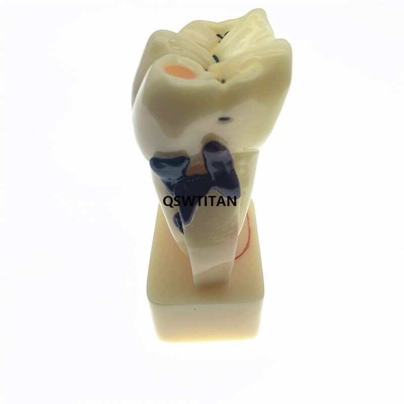 Teeth Model 4 times tooth pathology model Periodontal Teaching Study model