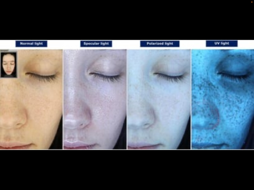 GLIMPSE – PROFESSIONAL SKIN ANALYZER 2024