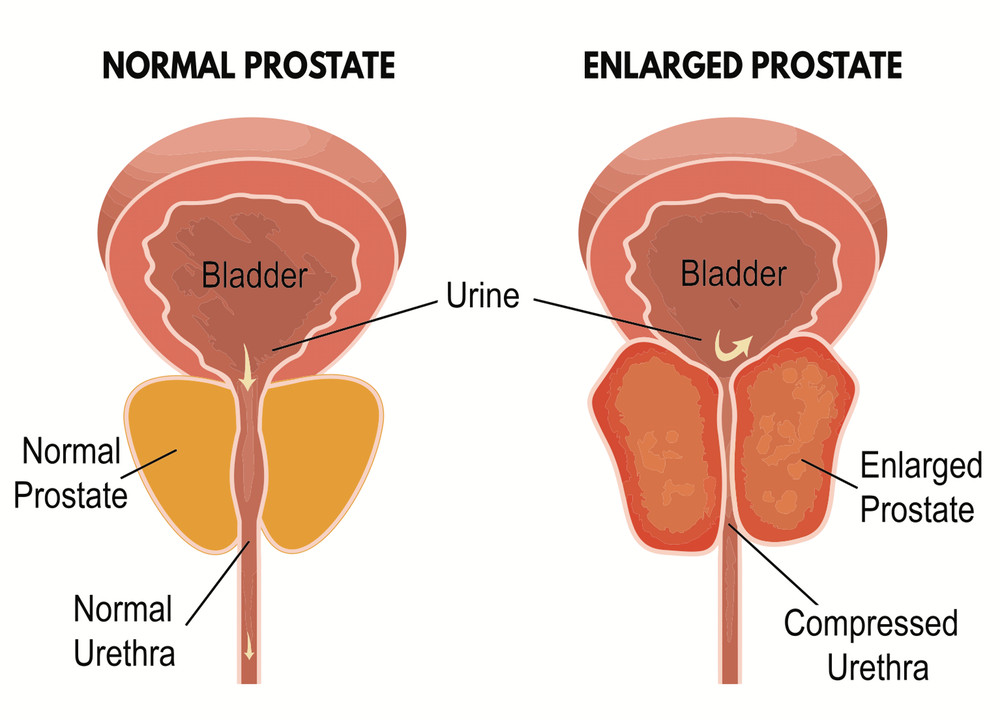 urinary pain relief- PROSTATE SUPPORT Advanced Complex -1B- Graviola B-6