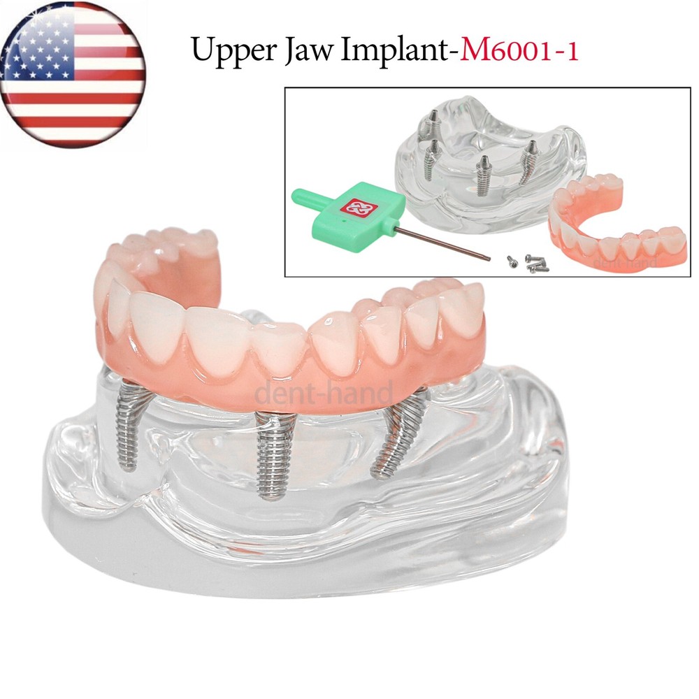 US Dental Overdenture Upper/Lower 4 Implants Demo Teeth Restoration Model