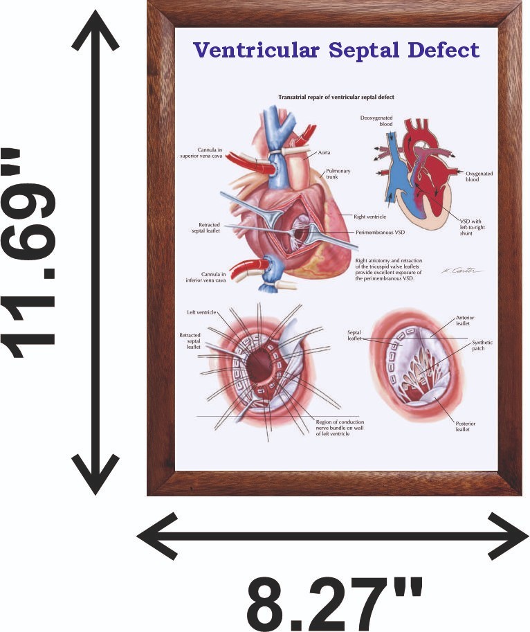 Ventricular Septal Defect Chart 12x18 inches