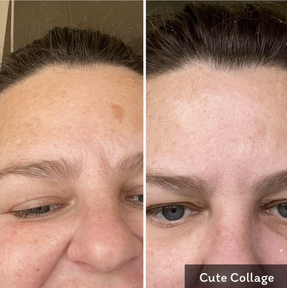 Dark Spot Remover for Face, Dark Spot Corrector, Hyperpigmentation Treatment 1oz