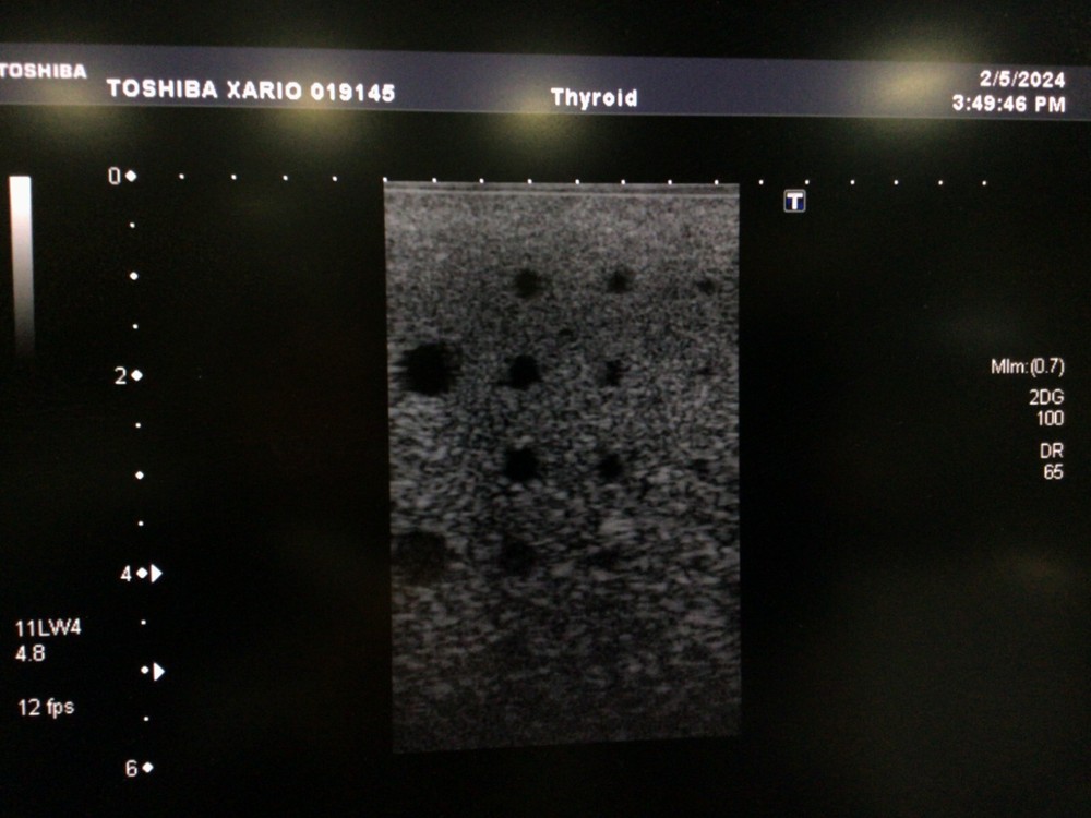 Toshiba PLT-704SBT Linear Array Ultrasound Probe Great Condition