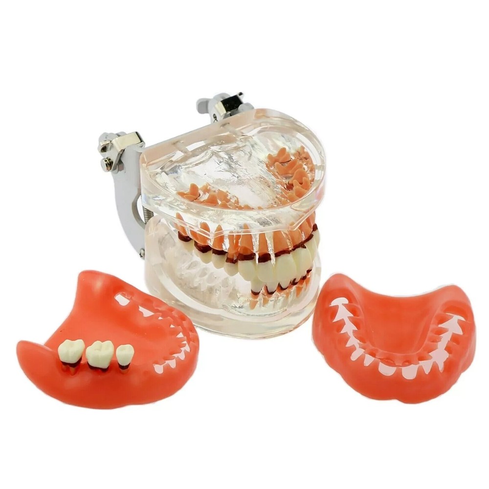 Dental Teeth Model Pathological Disease M4017 Removable Teaching Study Model