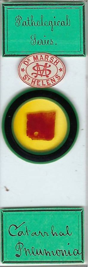 Human Catarrhal Pneumonia Pathology Microscope Slide by Dr. Sylvester Marsh