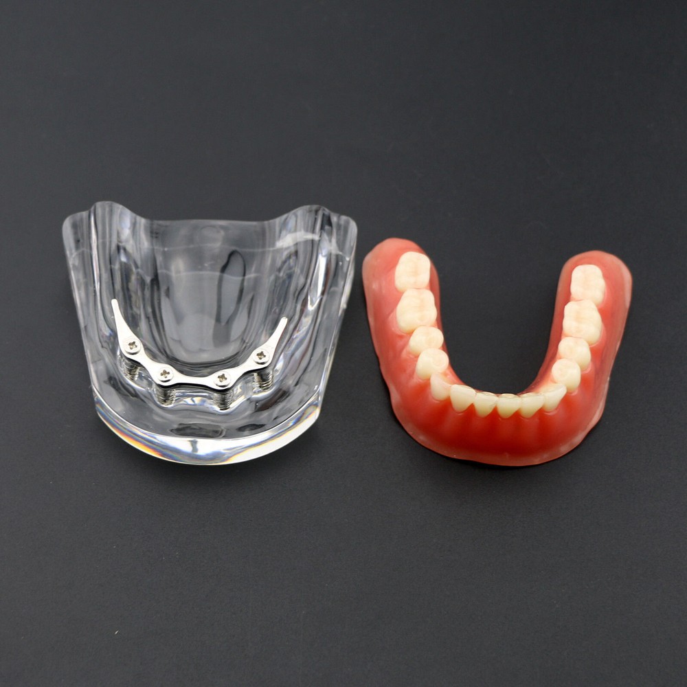 Dental Overdenture Study Demo Model Inferior M6008 Lower 4implants Silver Teeth